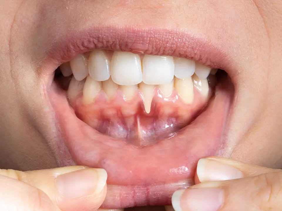 Natural methods to strengthen gums and improve oral health